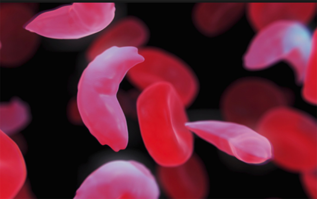 Está variante de anemia afecta específicamente una proteína que se encuentra en los glóbulos rojos./Especial