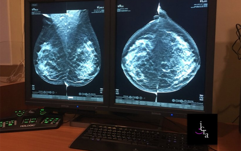 Las mamografías detectan el cáncer de mama temprano, cuando es más fácil de tratar./Especial