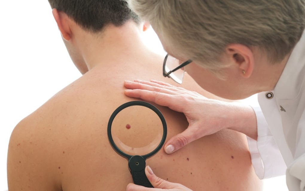 Estas son las claves para prevenir el cáncer de piel/ Foto: iStock