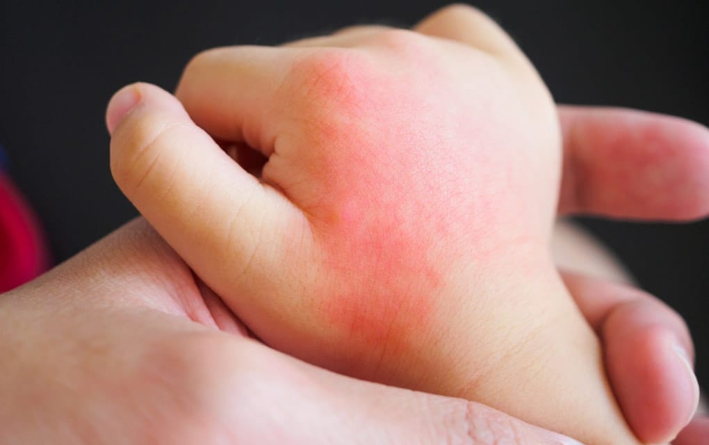 ¿Cómo reconocer los diferentes tipos de dermatitis en mi bebé