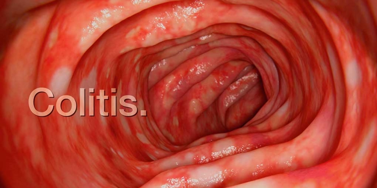 Colitis, un problema de salud muy frecuente y poco tratado