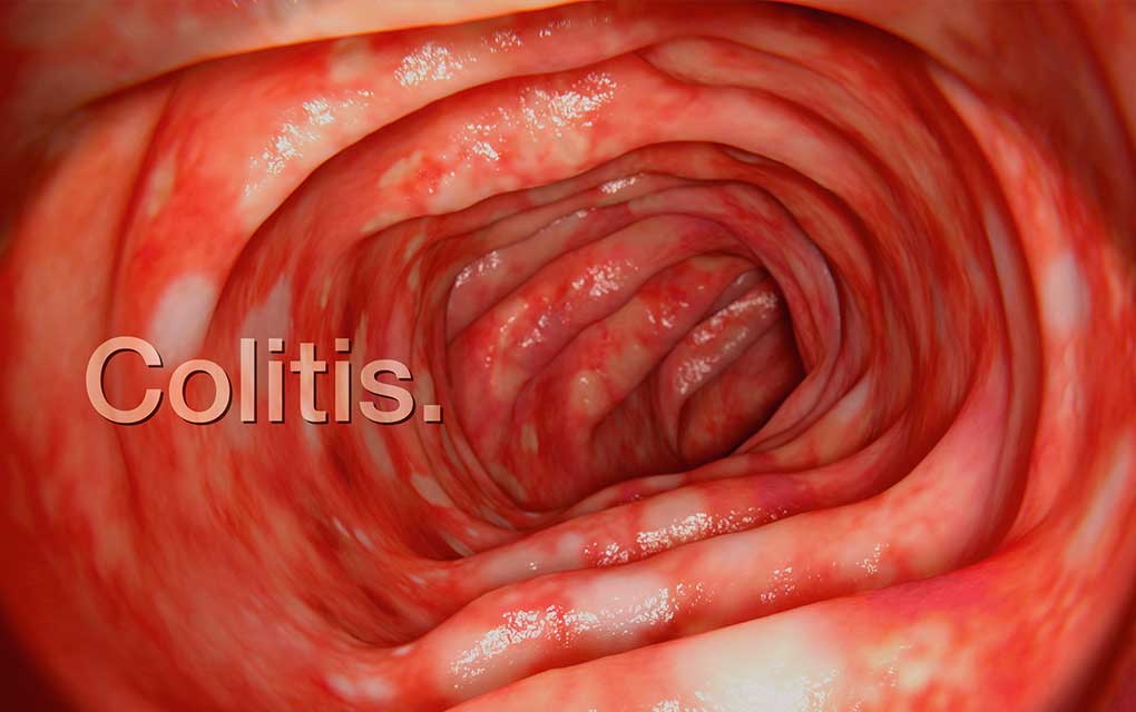Colitis, un problema de salud muy frecuente y poco tratado
