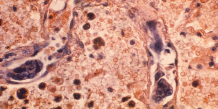 Imagen de un tejido de pulmón afectado con cáncer. Imagen de 1964 facilitada por los Centros de Control y Prevención de Enfermedades de EEUU. (Dr. Ellis/Universidad de Emory, Departamento de Patología/CDC via AP)