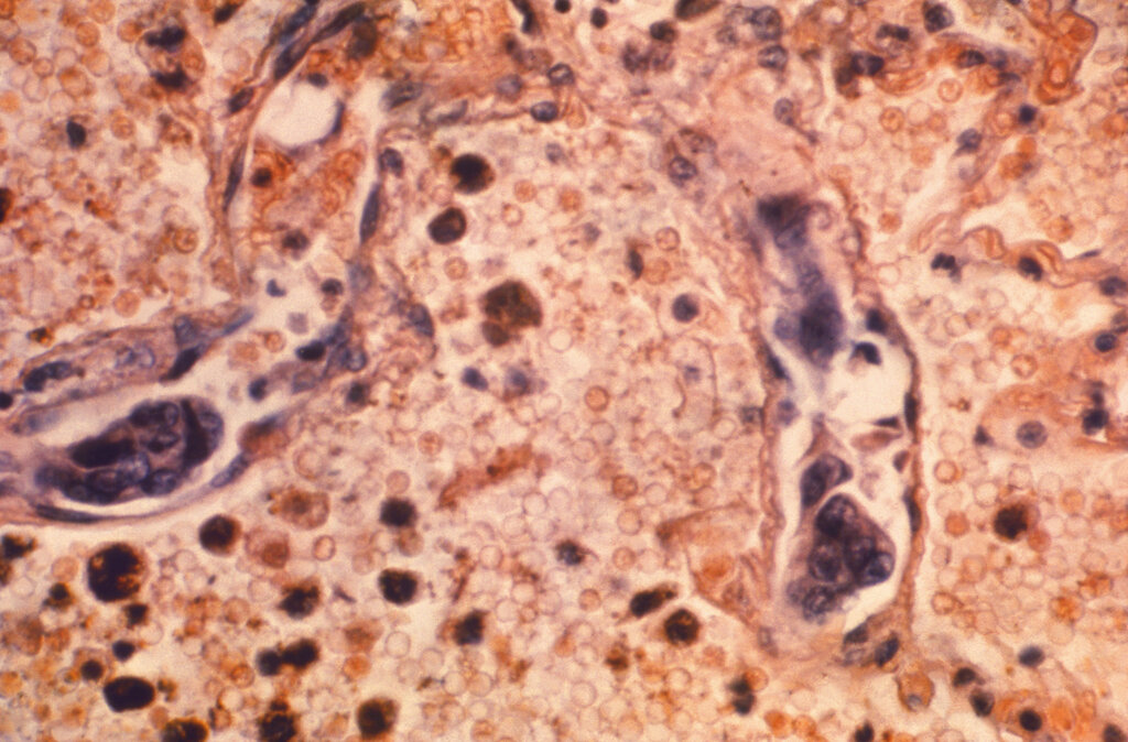 Imagen de un tejido de pulmón afectado con cáncer. Imagen de 1964 facilitada por los Centros de Control y Prevención de Enfermedades de EEUU. (Dr. Ellis/Universidad de Emory, Departamento de Patología/CDC via AP)