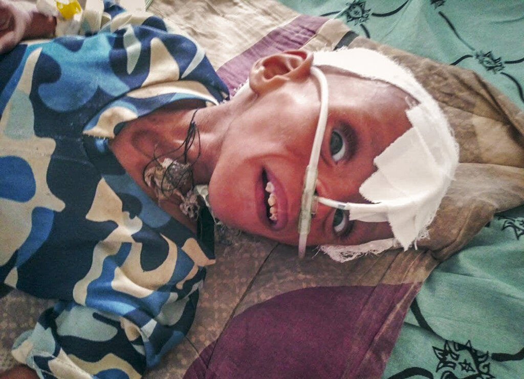 Un niño con grave malnutrición recibe tratamiento en una unidad de cuidados intensivos en el Hospital de Referencia de Ayder. (AP)