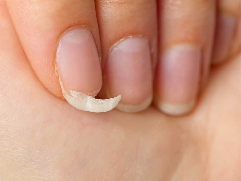 ¿Por qué se enferman las uñas? / Foto: iStock