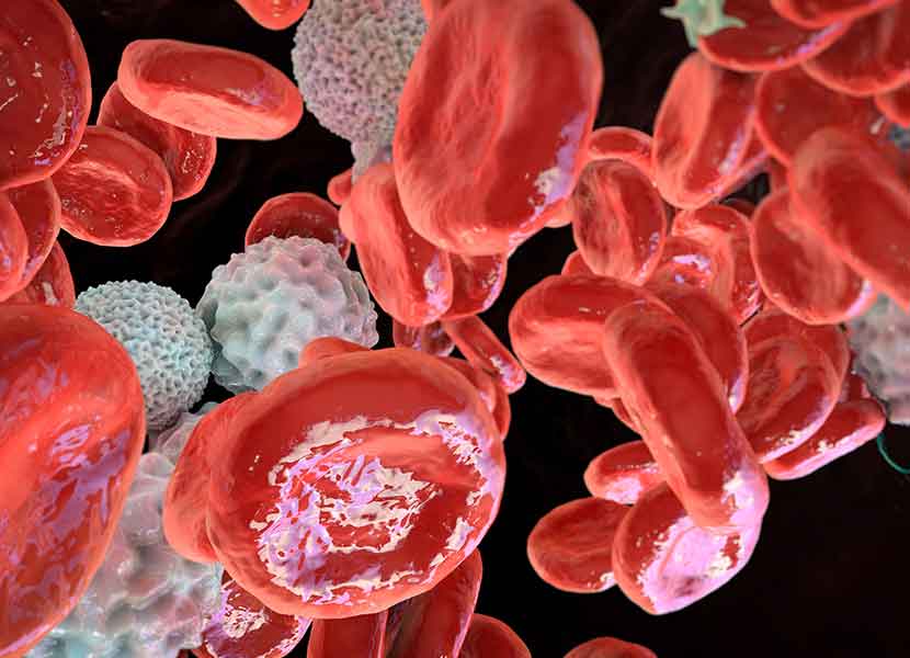 En México, la leucemia y el linfoma son los dos tipos de cánceres hematológicos que más afectan a la población. / Foto: iStock