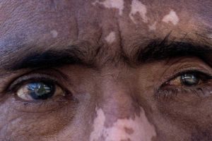Mexicanos, los más propensos a desarrollar ceguera