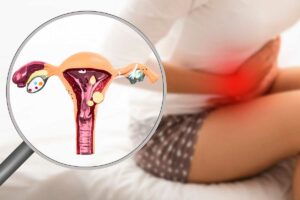 Síntomas de la endometriosis y qué hacer