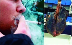 Médico explica graves daños del tabaco, muestra pulmón de un fumador
