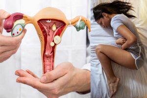 Día Mundial de la Endometriosis: ¿Qué es y cuáles son sus síntomas?
