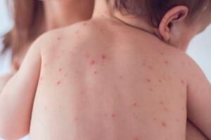 Secretaría de Salud confirma primer caso de sarampión en CDMX